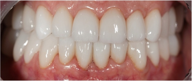Комплексное протезирование керамическими винирами по технологии CEREC во фронтальных участках. Коронки и мосты из диоксида циркония на жевательные зубы.